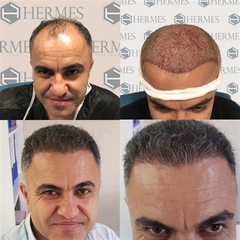 hermes istanbul|hermes hair clinic istanbul.